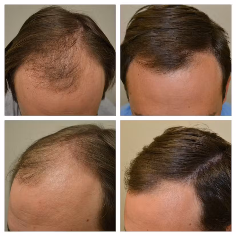 resultados minoxidil kirkland argentina